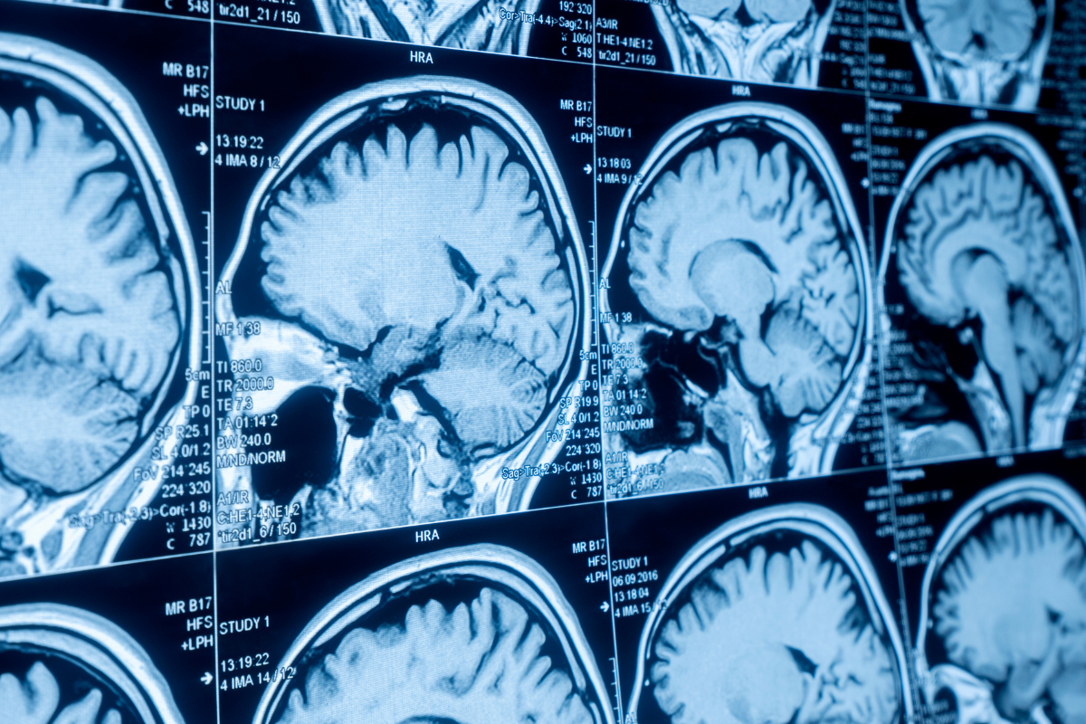 Brain scan